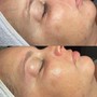 Dermaplaning