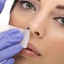 MicroNeedling