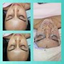 Dermaplaning