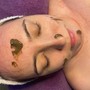 Chemical peels