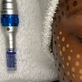 Microneedling