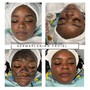 Intro Facial (Before receiving a peel)