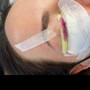 Microdermabrasion Facial