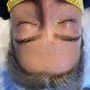 Microdermabrasion Facial