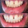 Teeth Whitening (60 Minute Session)