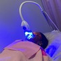 MicroNeedling