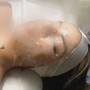 Acne Facial