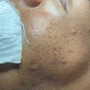 Dermaplane