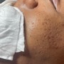 Precision Peel