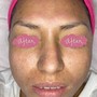 Acne Facial