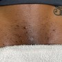 2 area inkless scar revision