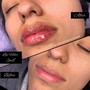 Lips- 1 mL Filler