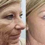 Oxygen Facial