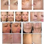 Dermaplaning