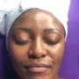 Microdermabrasion