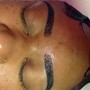 Microdermabrasion