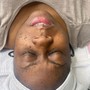 Microdermabrasion