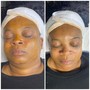 Dermaplane facial