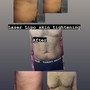 3Treatments Laser Lipo + Cavitation + tightening