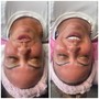 Dermaplane facial