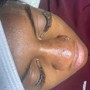 Acne Facial