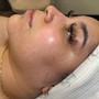 Dermaplaning Facial