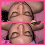 Dermaplaning Facial