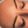 Microdermabrasion