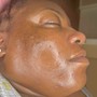 Dermaplaning