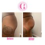 Cellulite Treatment