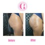 Cellulite Treatment