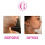 Chin Removal