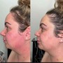 “The Works” Neurotris microcurrant face lift package of 3