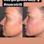 “The Works” Neurotris microcurrant face lift package of 3