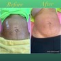 60 minute ultrasonic cavitation -6 sessions