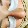 Microdermabrasion