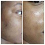 Decollete (Neck)Chemical Peel