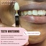 Teeth Whitening