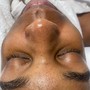 Chemical Peel