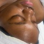 Chemical Peel