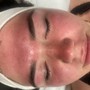 Chemical Peel