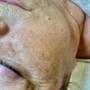 Chemical Peel