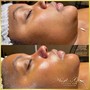 Acne Facial