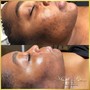 Acne Facial