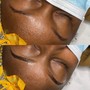 Acne Facial