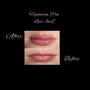 Lips- 1 mL Filler