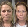 BOTOX GLOWTOX FACIAL