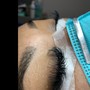 Dermaplaning