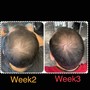 Pro High Frequency Scalp Massage Treatment (Combatting Hair Loss Therapy)