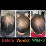 Pro High Frequency Scalp Massage Treatment (Combatting Hair Loss Therapy)